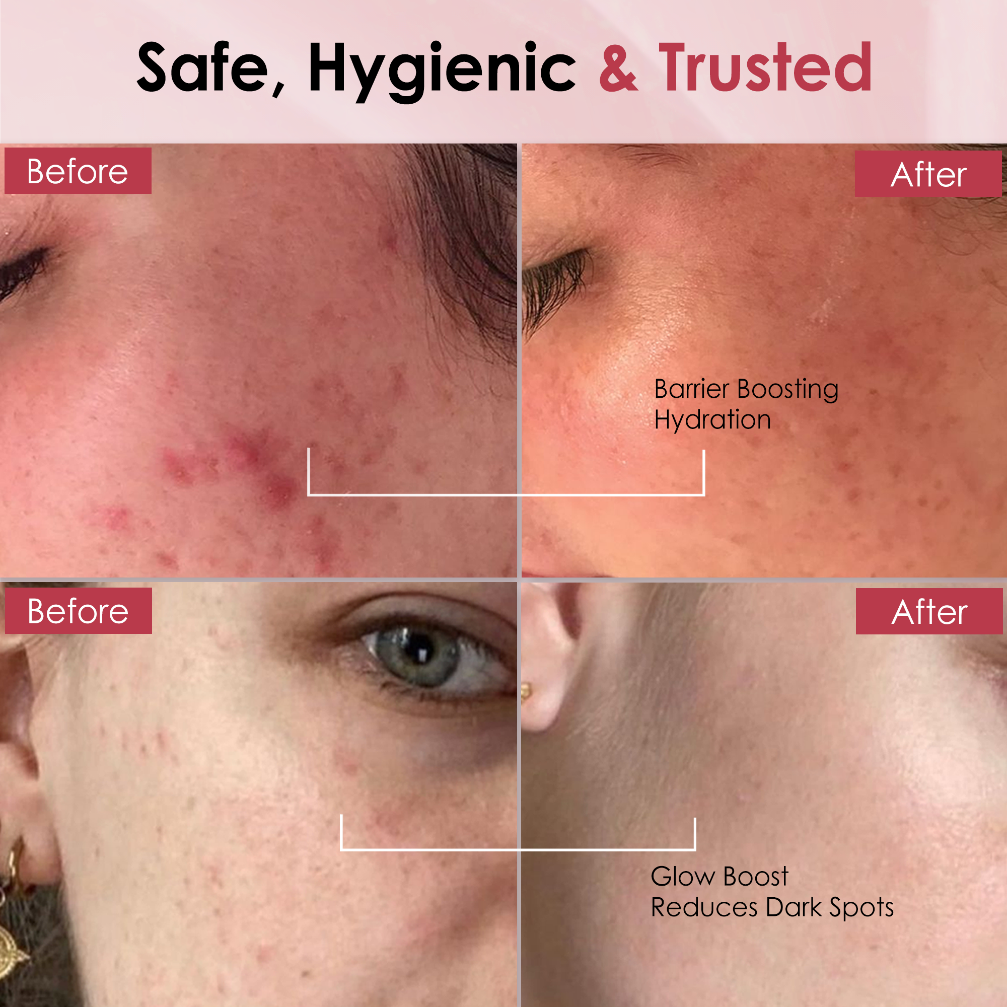 Anti-Acne Salicylic Acid 2% Face Wash – 100 ml